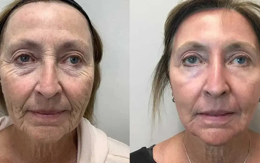 Antes e Depois Fernanda Lopes