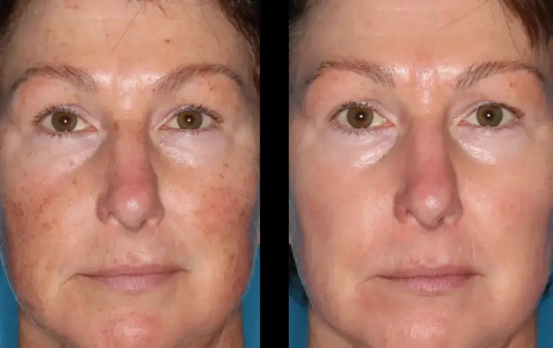 Antes e Depois Marina Costa