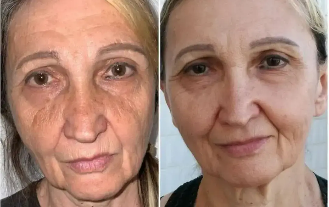 Antes e Depois Simone Oliveira