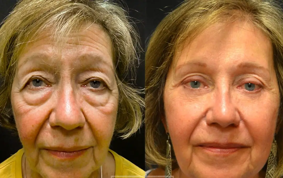 Antes e Depois Jéssica Almeida